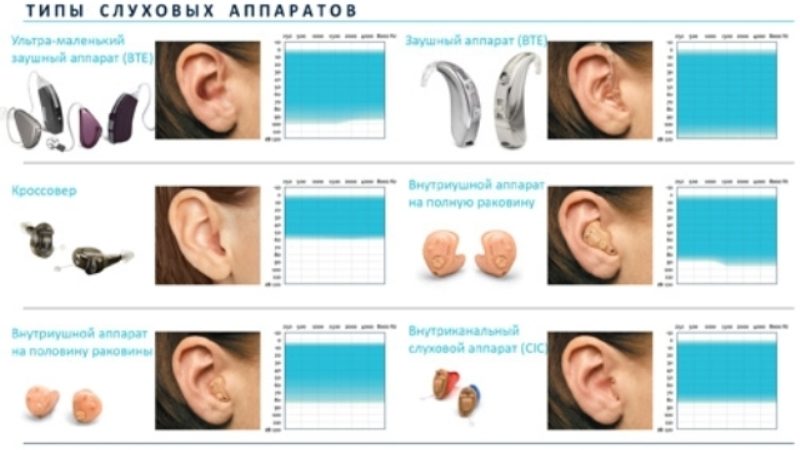 Слуховые аппараты бывают. Типы слуховых аппаратов. Вдыслуховых аппаратов. Типы ушных аппаратов. Какие бывают слуховые аппараты виды.