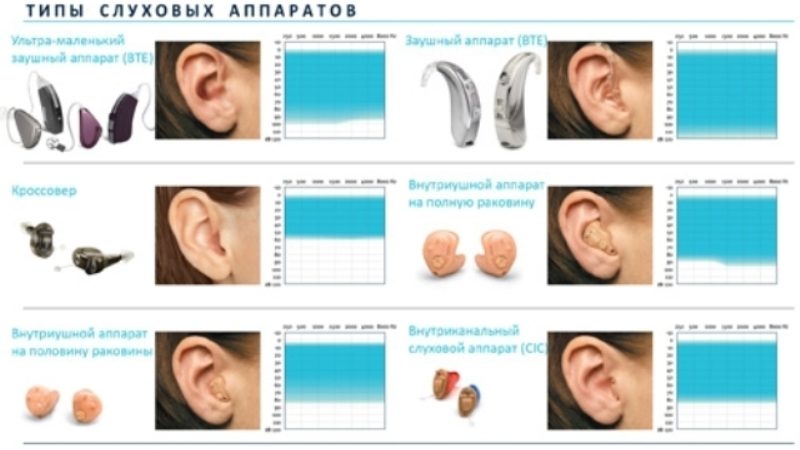 Типы слуховых аппаратов. Типы ушных аппаратов. Какие бывают слуховые аппараты виды. Типы ношения слуховых аппаратов.